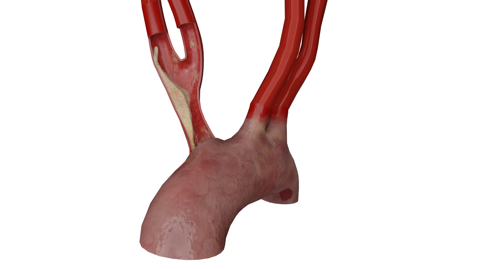 Atherosclerosis of Aortic Arch Branches