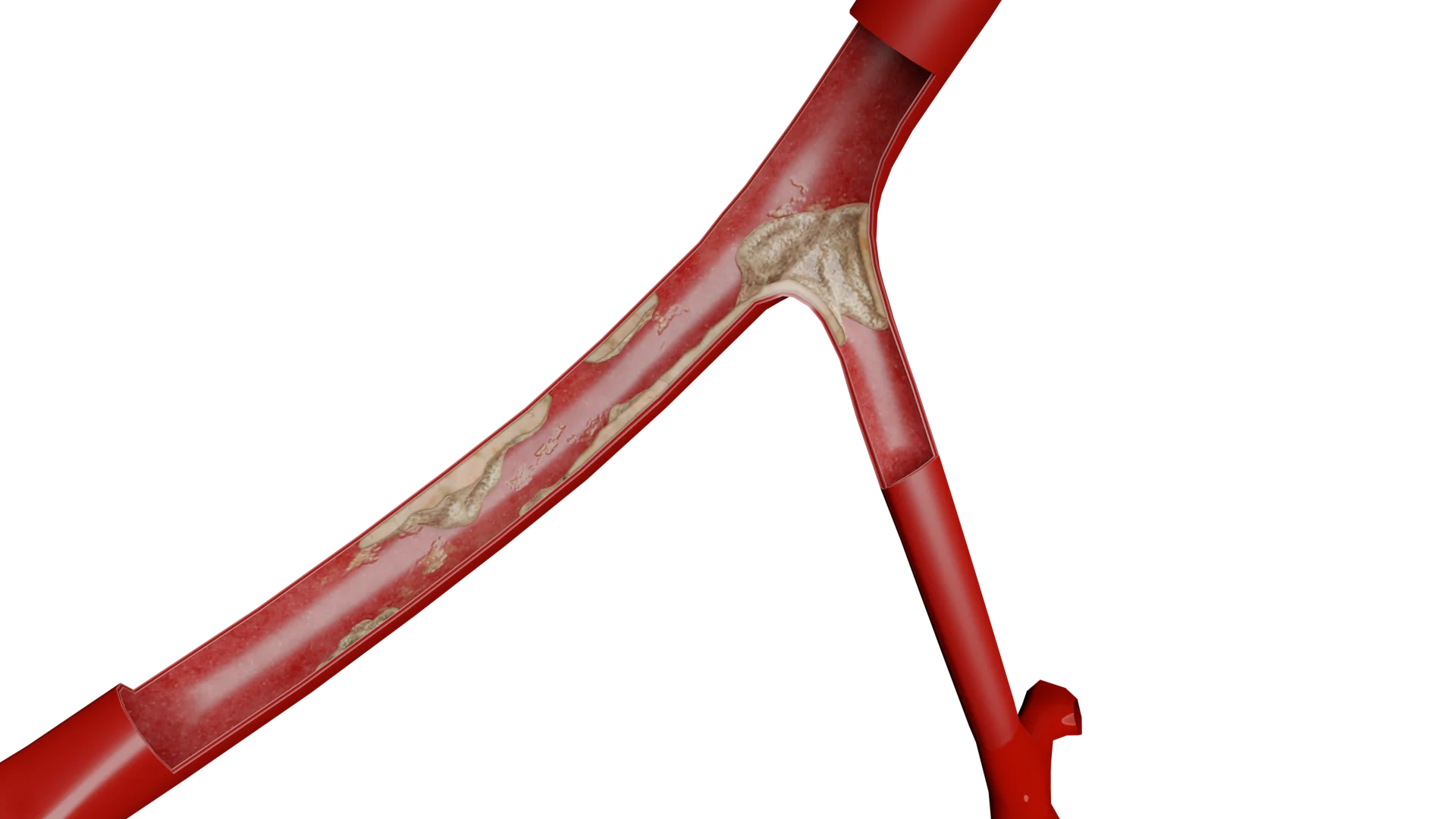 Atherosclerosis of Iliac Arteries