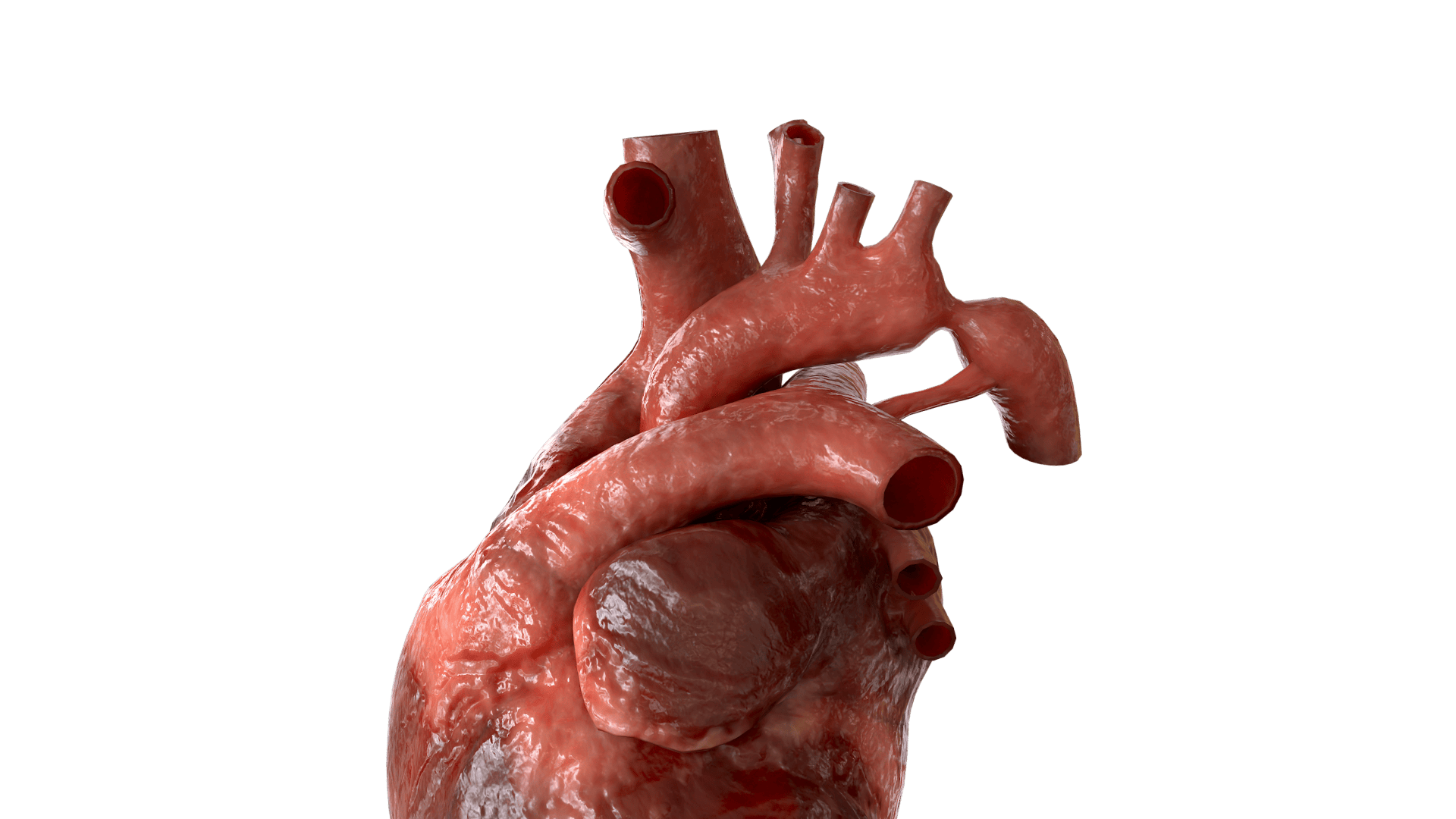 Coarctation of the Aorta