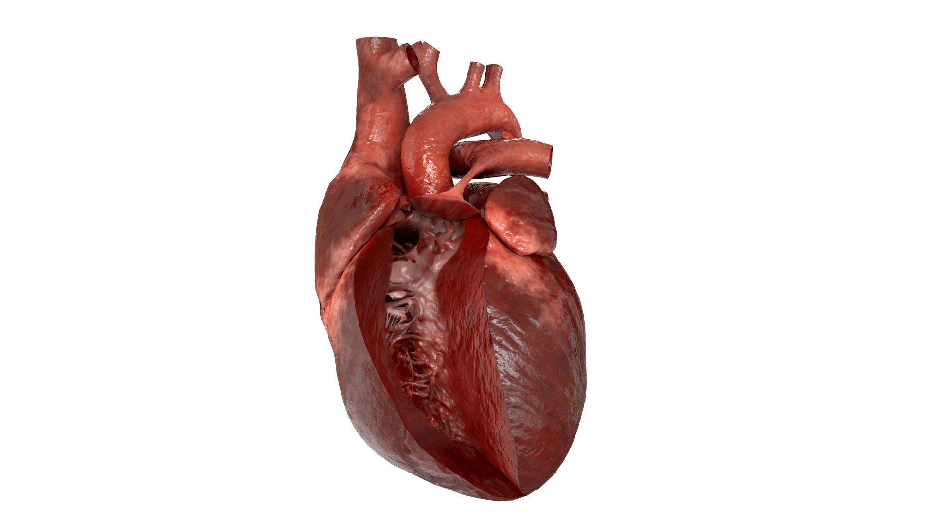 Tetralogy of Fallot